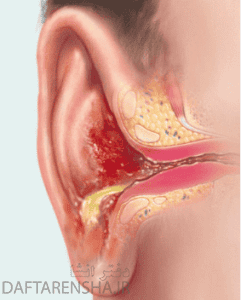 پیشگیری از عفونت های گوش